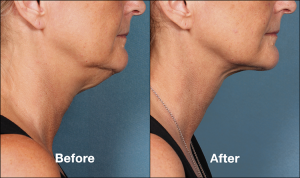 Kybella for Chin Fat Reduction | Non-Surgical | Las Vegas Nevada