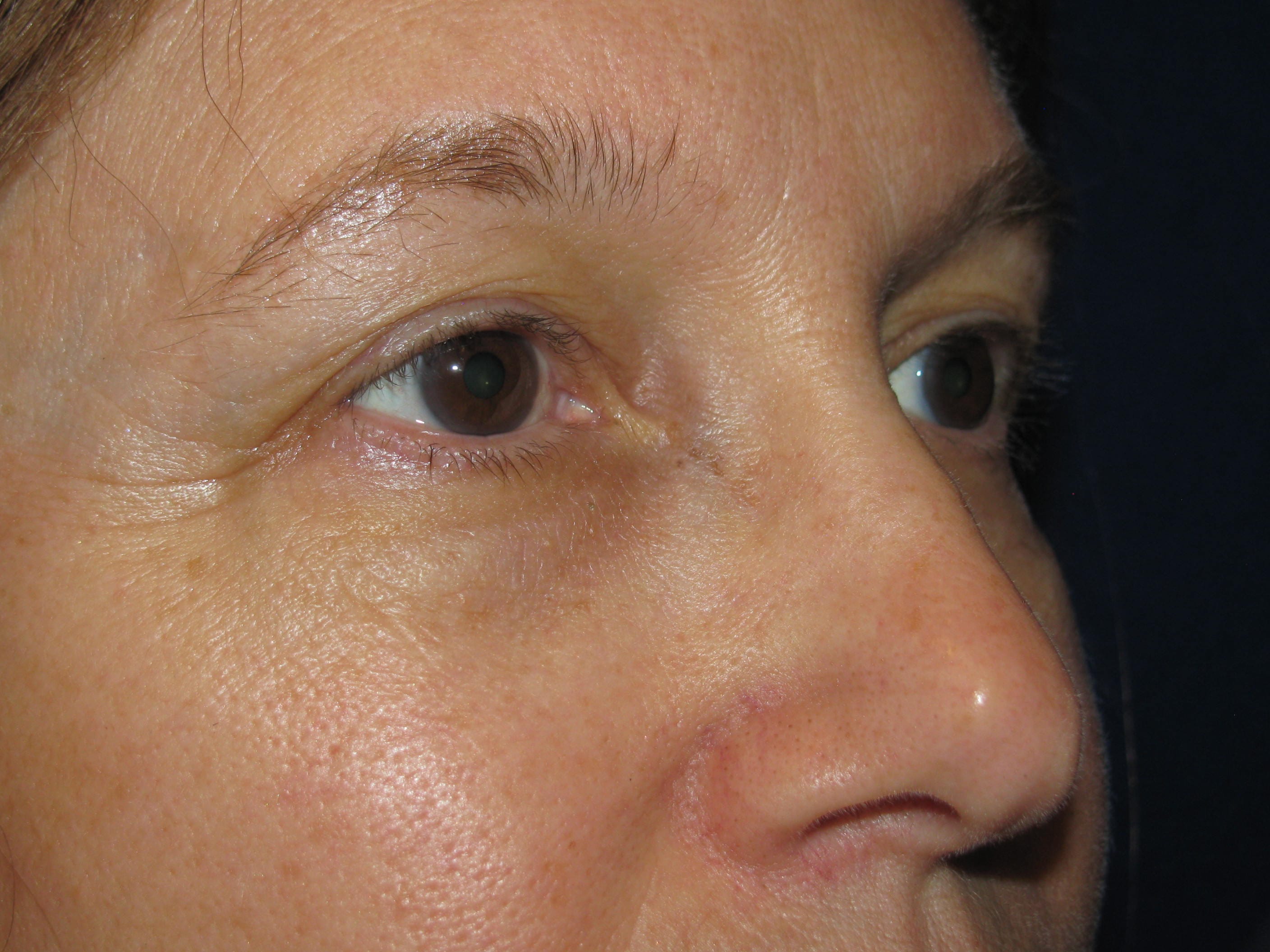 Upper Blepharoplasty Before and After | LV Plastic Surgery