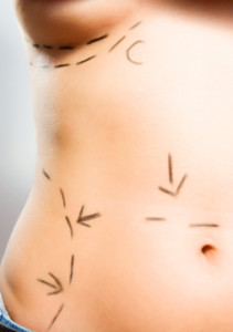 liposuction las vegas