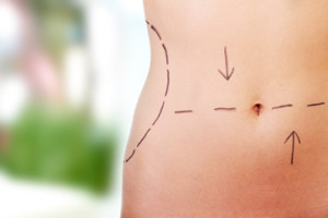 Liposuction Before and After Photos Las Vegas