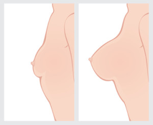 Breast Augmentation Surgery