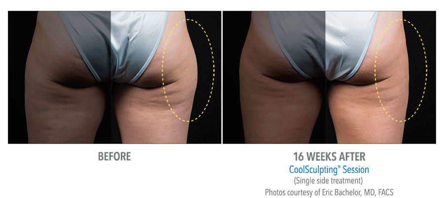 The Average Cost of CoolSculpting