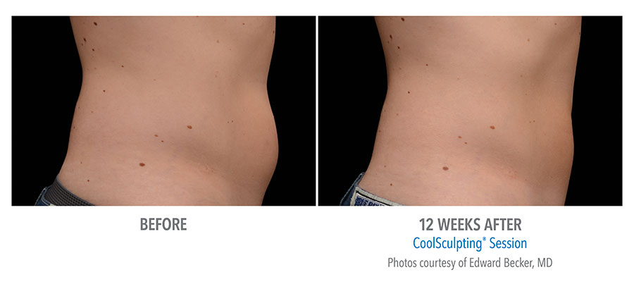 CoolSculpting Fat Removal - Style Aesthetics by RajaniMD