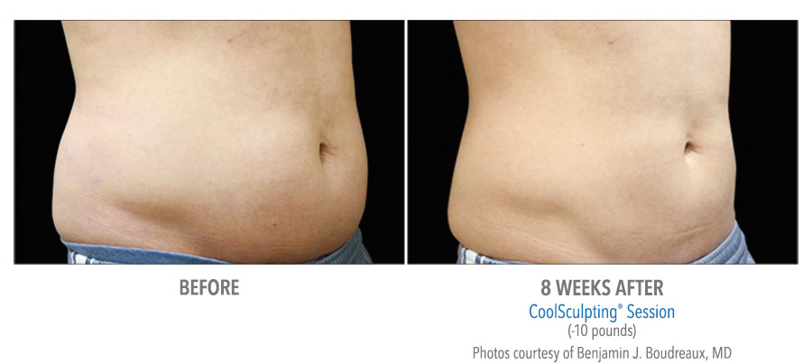 CoolSculpting Fat Removal - Style Aesthetics by RajaniMD