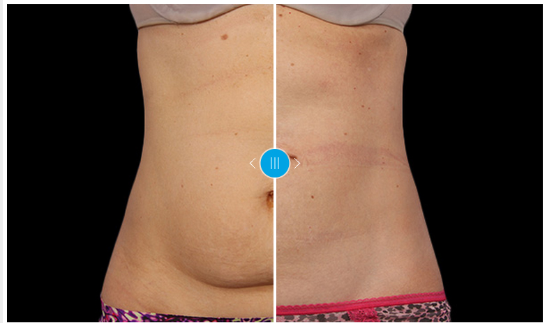 coolsculpting before and after pictures