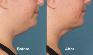 Kybella Before + After Photos - Purely Aesthetics