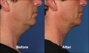 Kybella Chin Fat Reduction Injections Cost | Las Vegas