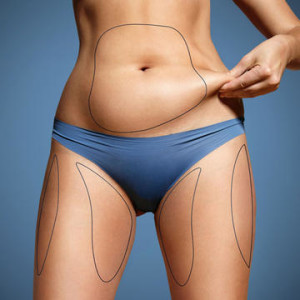 Freeze what you can squeeze with CoolSculpting - Las Vegas Plastic Surgery