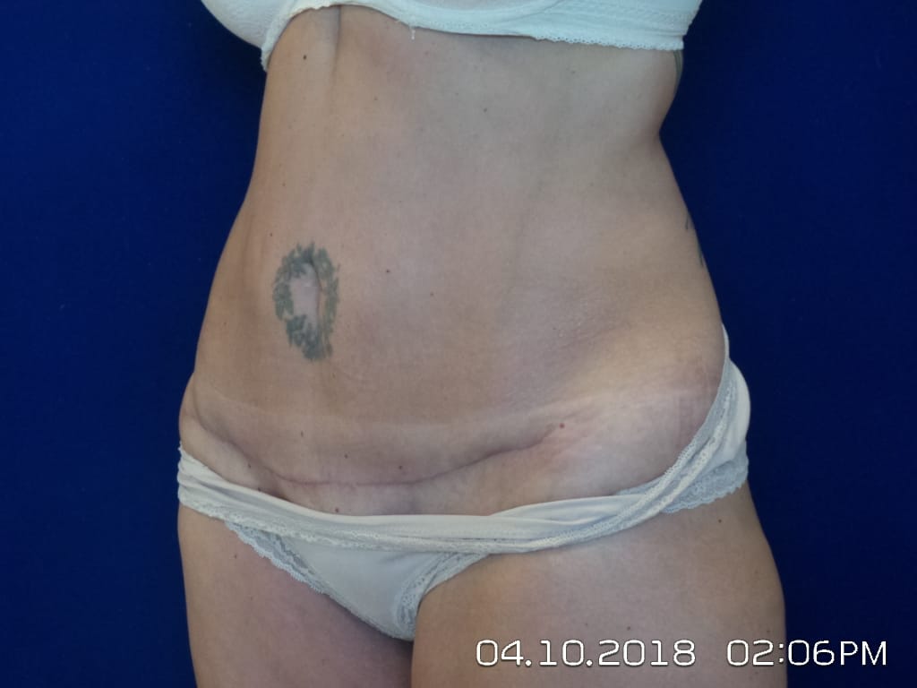Tummy Tuck in Las Vegas, NV, Abdominoplasty Cost